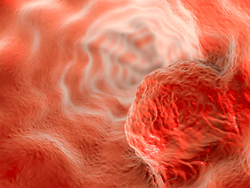 a imagem ilustra um tumor no esôfago