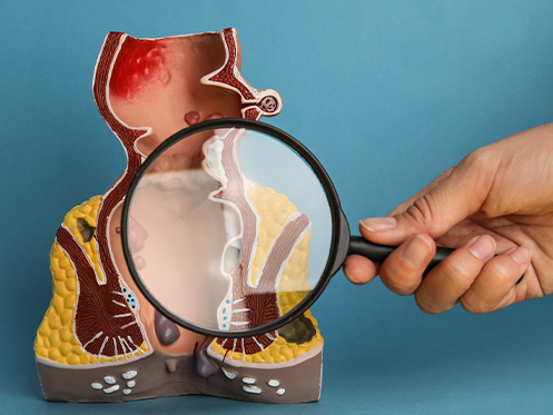 A imagem ilustra uma pessoa com uma lupa investigando se há emorroida.